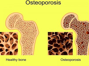 dt_160725_osteoporosis_800x600